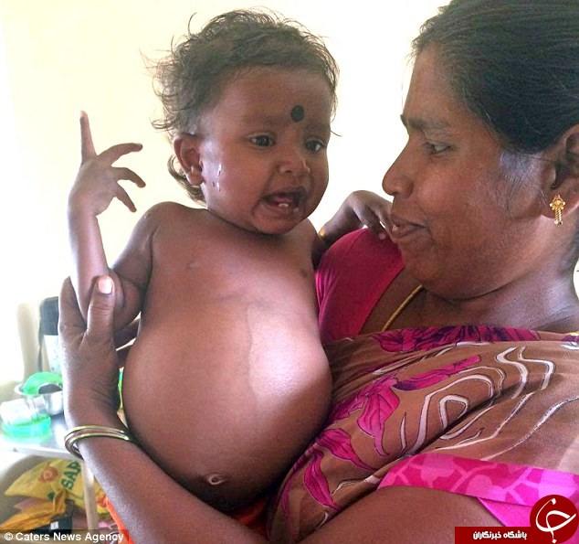 نوزاد دختری 15 ماهه که دوقلو باردار بود+تصاویر