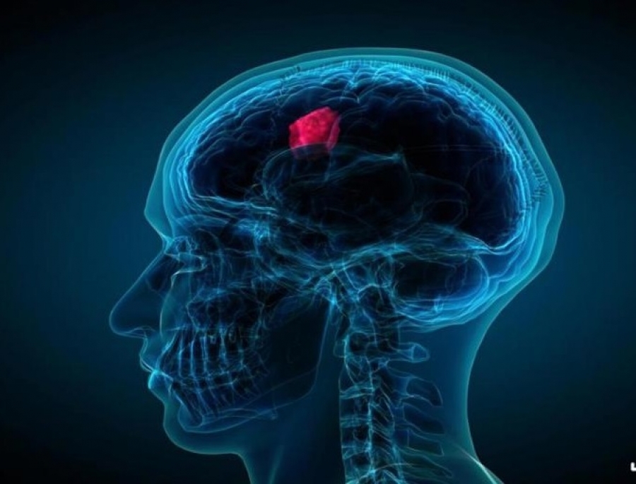 افزایش میزان نیترات در بدن یعنی سرطان و تومور افزایش میزان نیترات در بدن یعنی سرطان و تومور