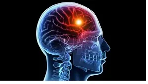 چگونه یک سکته مغزی را تشخیص دهیم؟