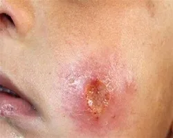 کاهش 15 درصدی ابتلا به سالک در اصفهان